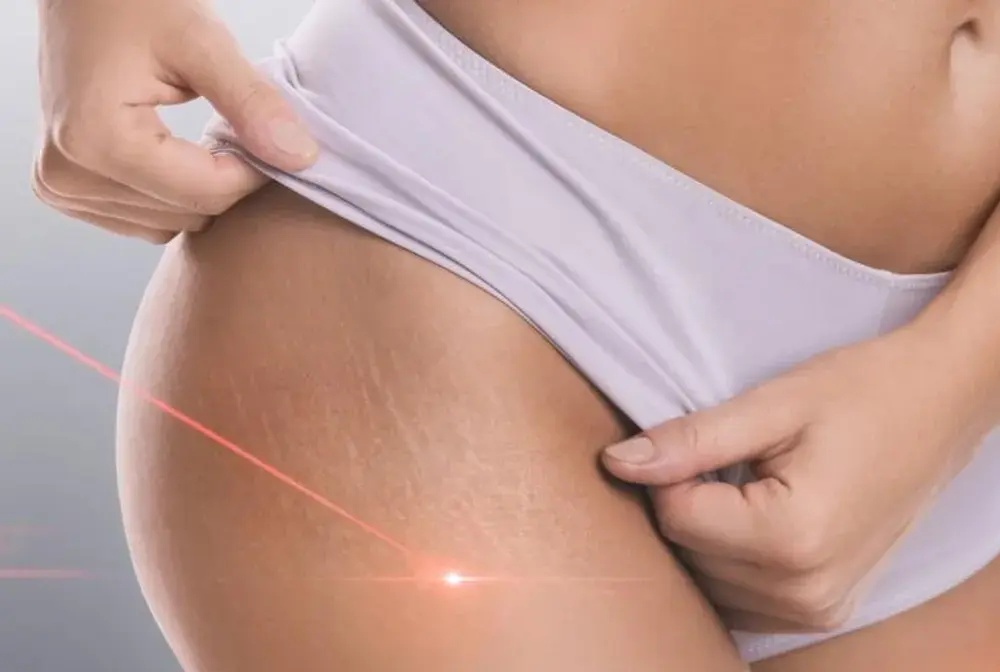 Laserowe usuwanie rozstępów - Czy warto? Poznaj realne efekty i ceny