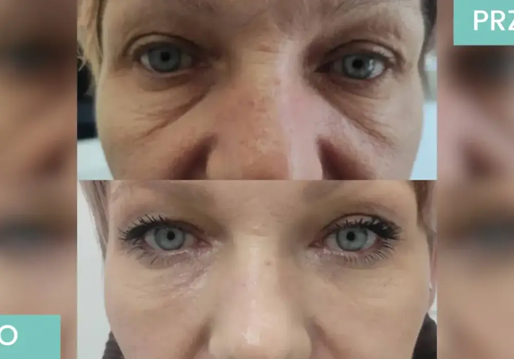 Stymulatory tkankowe - jak naturalnie zagęścić i ujędrnić skórę?