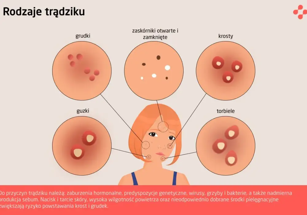 Rodzaje pryszczy - jak je rozpoznać i skutecznie leczyć?
