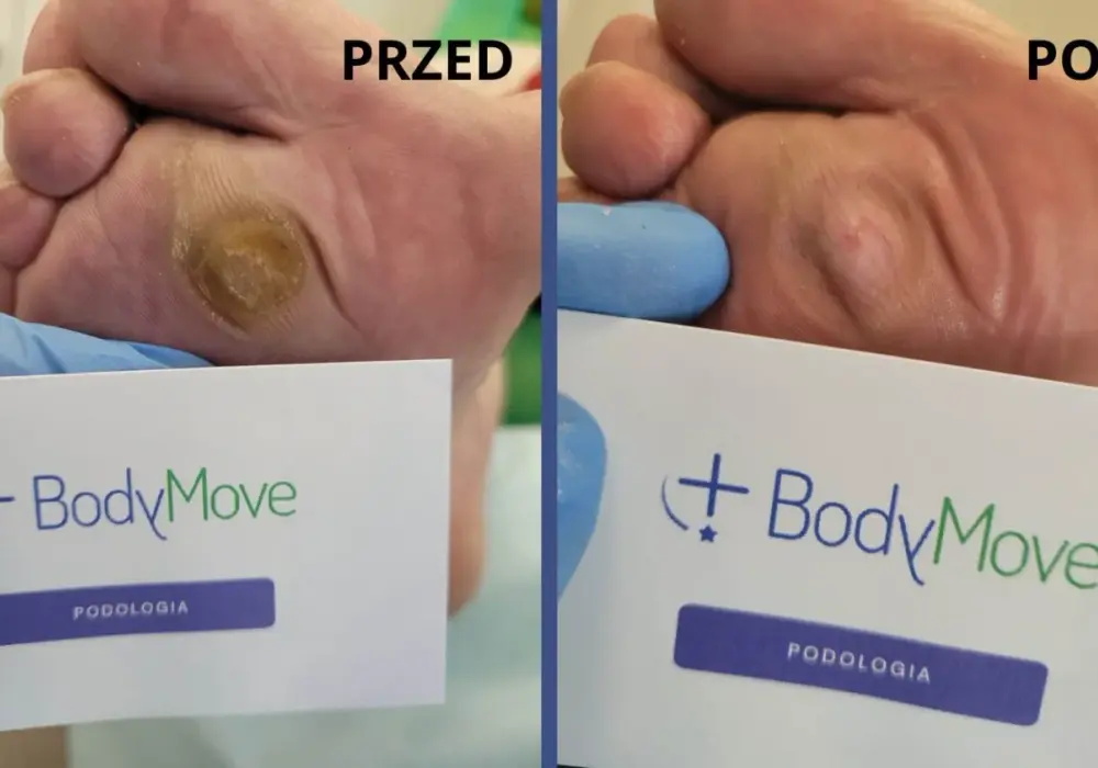Modzele przed i po usunięciu - Dlaczego wracają i jak temu zapobiec?