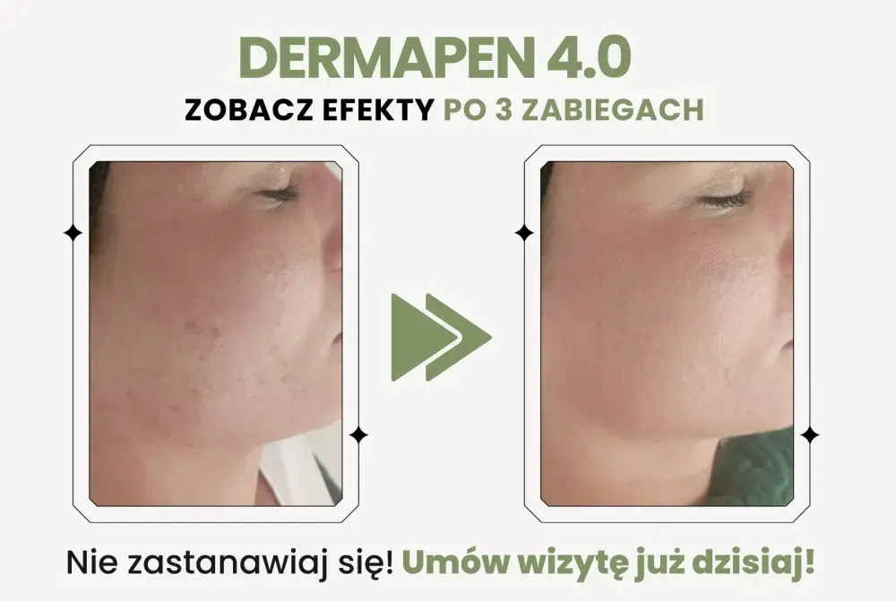 Dermapen po 3 zabiegach - Jakie są efekty i czy to wystarczy?