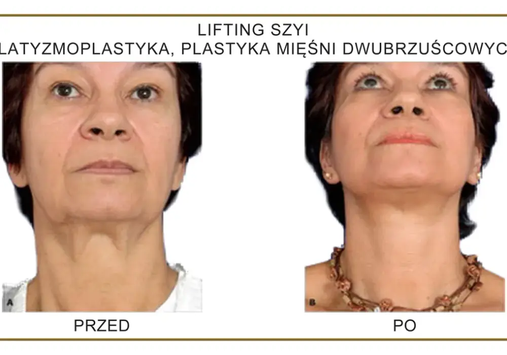 Lifting szyi - operacja, botoks czy nici? Sprawdź, co naprawdę działa