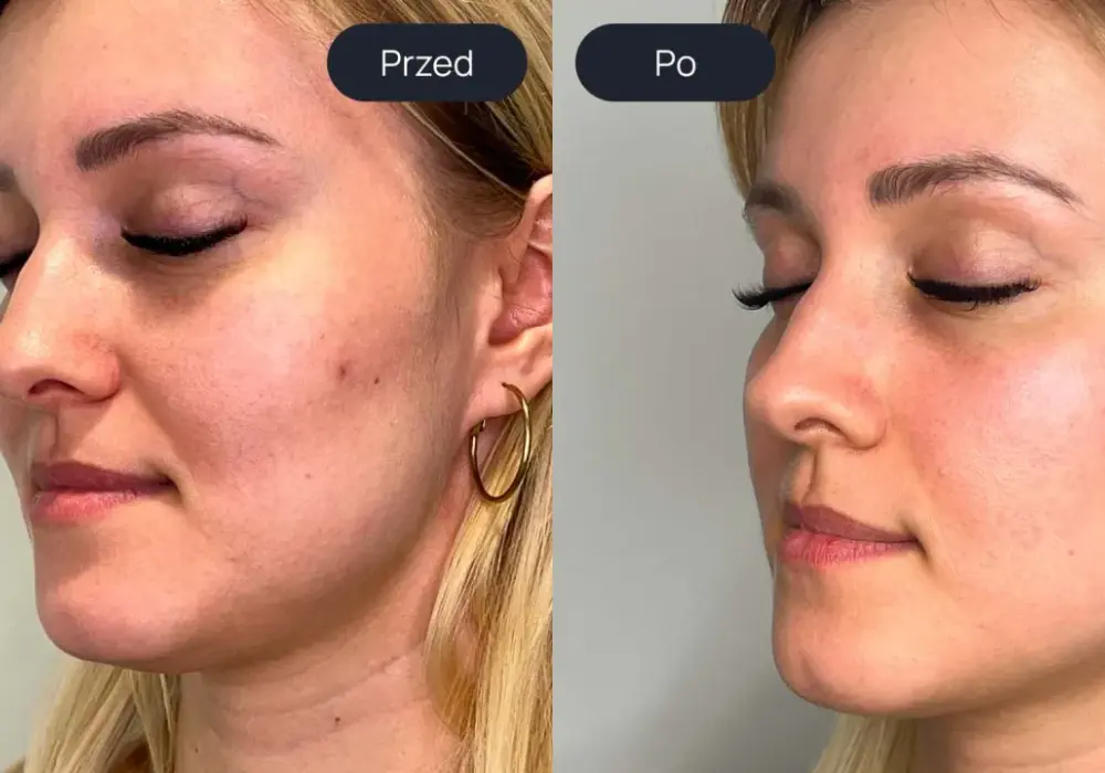 Laser tulowy efekty - Czego realnie oczekiwać po zabiegu?