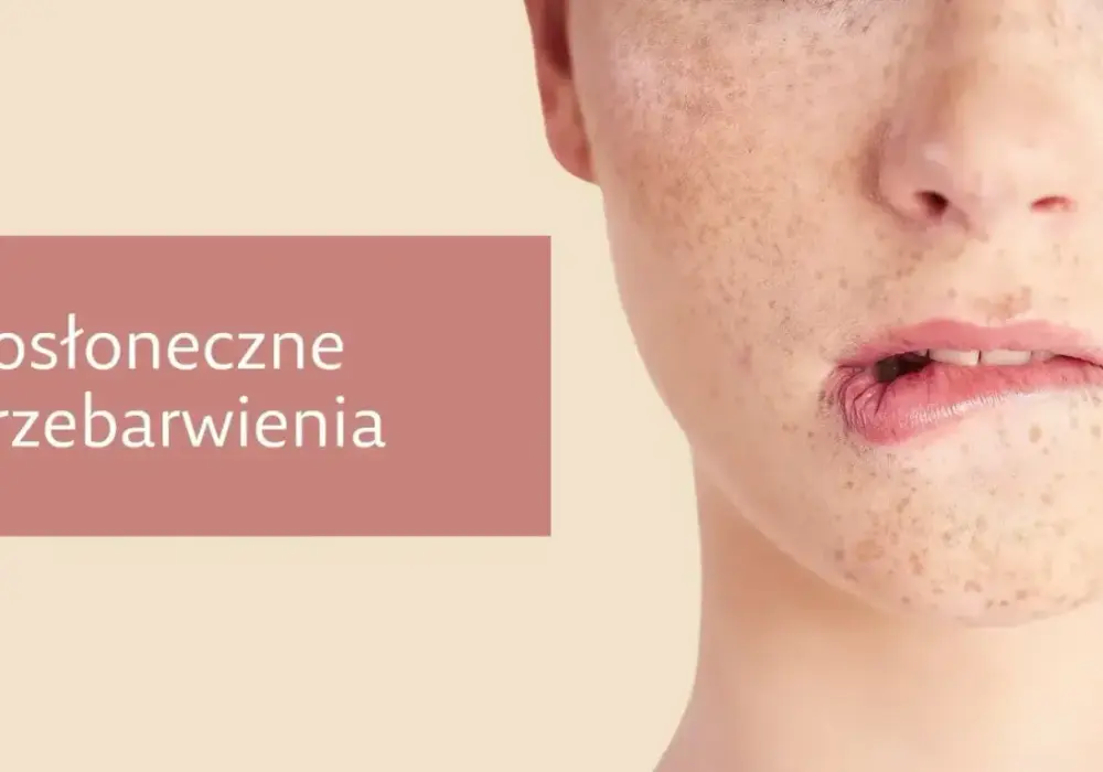 Melasma i przebarwienia na twarzy - Jak skutecznie wyrównać koloryt?