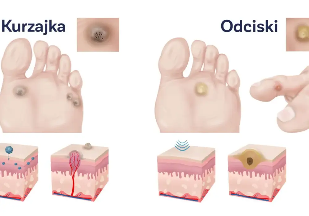 Odciski na stopach - Jak usunąć je bezpiecznie i bez nawrotów?