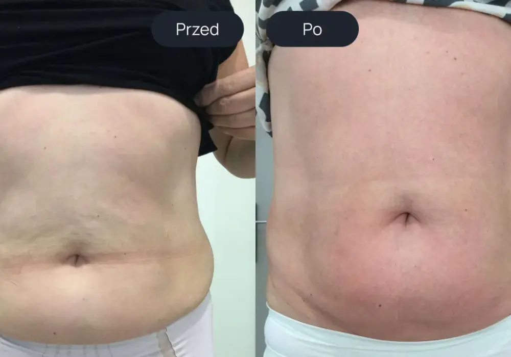 Endermologia - czy 5 zabiegów wystarczy? Poznaj realne efekty