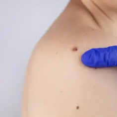 Lekarz w niebieskiej rękawiczce bada pieprzyki na ramieniu. Różne rodzaje znamion skórnych są widoczne.