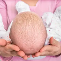 Główka niemowlęcia z objawami rybiej łuski choroby. Skóra jest sucha, łuszcząca się, z widocznymi białymi łuskami.