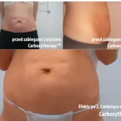 Brzuch przed i po karboksyterapii. Widoczne zmniejszenie rozstępów i poprawa napięcia skóry. Efekty po 2,5 miesiąca.
