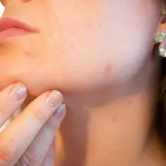 Delikatne strupki po depilacji laserowej na skórze twarzy, widoczne podczas dotykania brody.