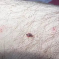 Zbliżenie na skórę z włosami, widoczne są drobne, czerwone pieprzyki na ciele, jeden z nich jest ciemniejszy i lekko krwawi.