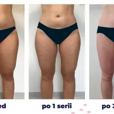 Przed i po kriolipolizie: widoczne efekty zabiegu na uda i brzuch po 1 i 2 seriach.