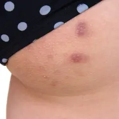 Skóra na pośladkach z widocznymi krostami i przebarwieniami, częściowo zakryta przez czarne majtki w białe kropki.