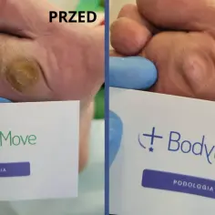Przed i po: widoczne modzele na stopie przed zabiegiem podologicznym i po nim. Skóra wygładzona, bez bolesnych zrogowaceń.