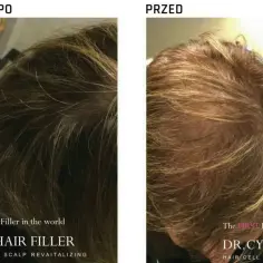Przed i po zabiegu DR.CYJ Hair Filler. Włosy widocznie gęstsze i zdrowsze.
