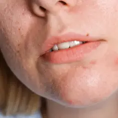 Zbliżenie na twarz z widocznym trądzikiem hormonalnym. Ktoś aplikuje krem na wyprysk na brodzie.