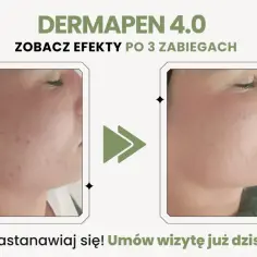 Dermapen 4.0: zobacz efekty po 3 zabiegach. Skóra przed i po, widoczna poprawa. Nie czekaj, umów wizytę!