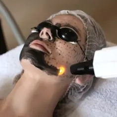 Kobieta w okularach ochronnych poddaje się zabiegowi peelingu węglowego. Laser skierowany na twarz.