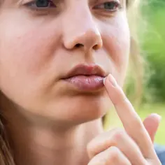 Kobieta aplikuje maść na **prosaki na ustach**. Widać zaczerwienienie i pęcherzyk.