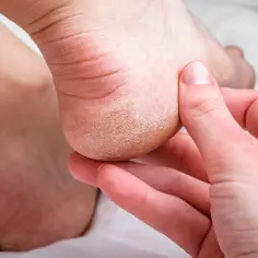 Dłoń dotyka pięty z widocznymi pęknięciami i łuszczącą się skórą, co świadczy o bardzo suchych stopach.