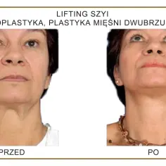 Przed i po zabiegu liftingu szyi. Widoczna poprawa napięcia skóry i konturu.