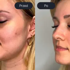 Przed i po zabiegu laserowym. Widoczne wygładzenie skóry i redukcja zaczerwienień, co pokazuje pozytywne laser tulowy efekty.