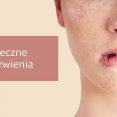 Zbliżenie na twarz z widocznymi przebarwieniami, które mogą być objawem melazmy.