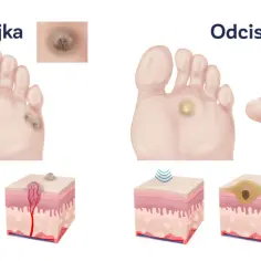Ilustracja porównuje kurzajki i odciski na stopach. Pokazuje domowe sposoby na odciski i kurzajki, ich wygląd i budowę.