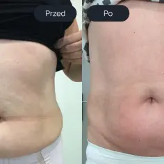 Porównanie brzucha przed i po 5 zabiegach endermologii. Widoczne wygładzenie skóry i redukcja tkanki tłuszczowej.