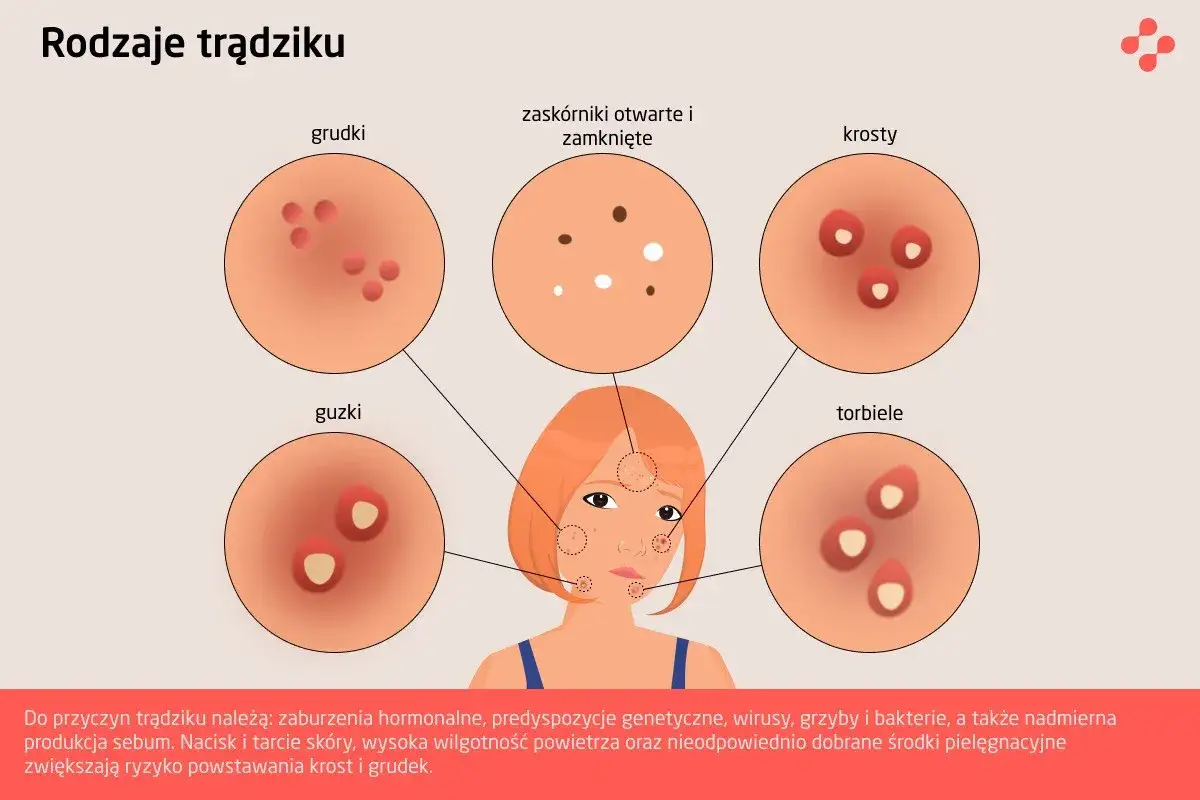 Ilustracja przedstawia różne rodzaje pryszczy: grudki, zaskórniki, krosty, guzki i torbiele, pokazując ich wygląd.