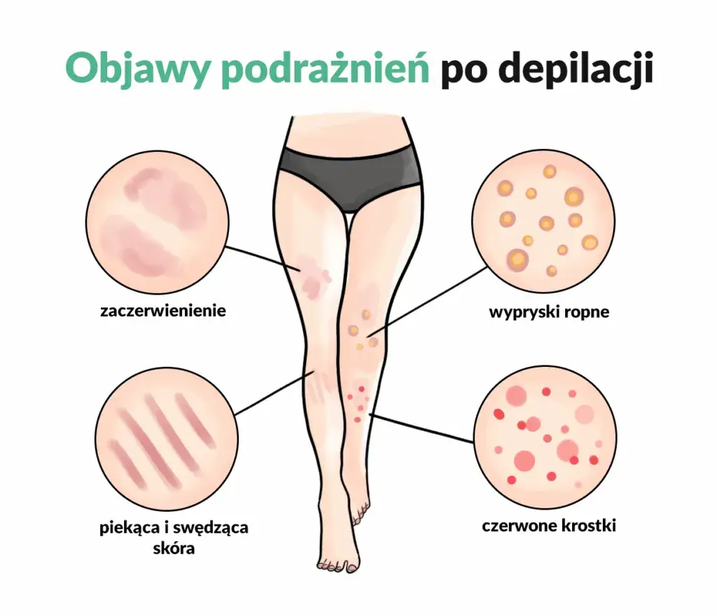 Zdjęcie Jak pozbyć się krostek po goleniu - skuteczne metody i porady