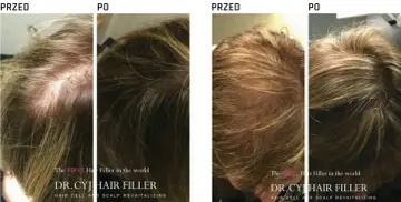 Przed i po zabiegu DR.CYJ Hair Filler. Włosy widocznie gęstsze i zdrowsze.