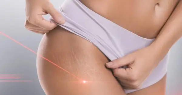 Laserowe usuwanie rozstępów - Czy warto? Poznaj realne efekty i ceny