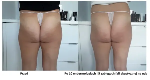 Skuteczne metody na cellulit - jak leczyć cellulit w domu i w gabinecie