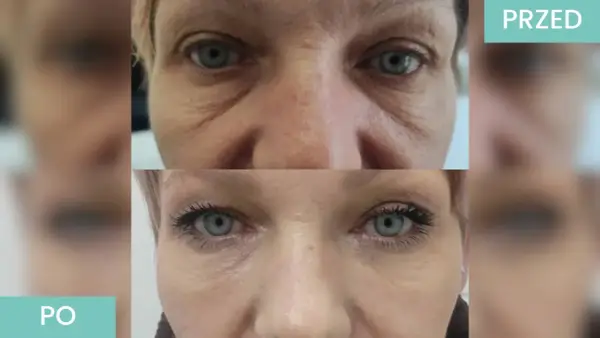 Stymulatory tkankowe - jak naturalnie zagęścić i ujędrnić skórę?