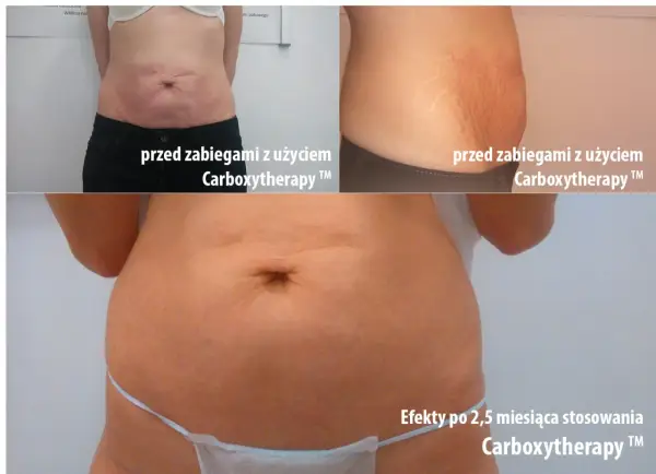 Karboksyterapia efekty - Realna poprawa skóry czy marketingowy chwyt?
