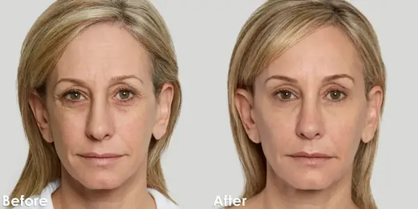 Biostymulator na bazie kwasu hialuronowego - kiedy warto go wybrać?