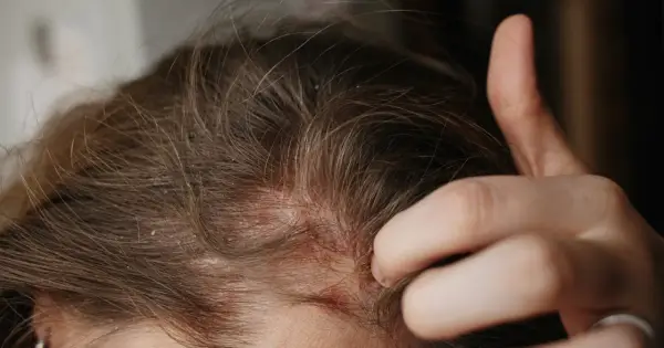 Łojotokowe zapalenie skóry głowy - leczenie i pielęgnacja