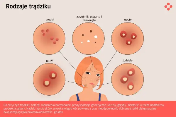 Rodzaje pryszczy - jak je rozpoznać i skutecznie leczyć?