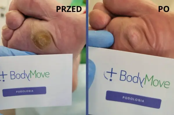 Modzele przed i po usunięciu - Dlaczego wracają i jak temu zapobiec?