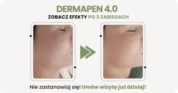 Dermapen po 3 zabiegach - Jakie są efekty i czy to wystarczy?