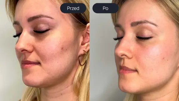 Laser tulowy efekty - Czego realnie oczekiwać po zabiegu?