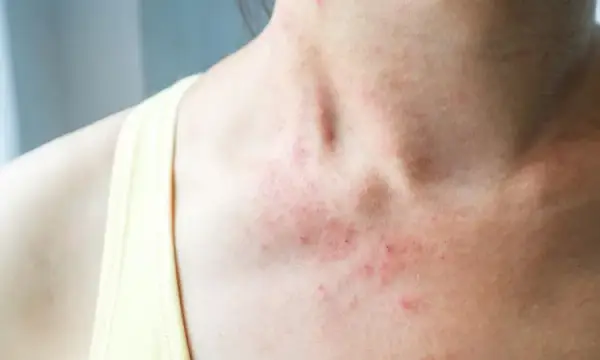 Skuteczne metody leczenia zapalenia mieszka włosowego i ich ryzyka