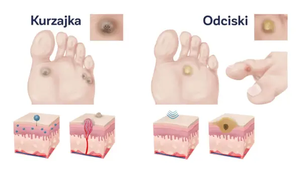 Odciski na stopach - Jak usunąć je bezpiecznie i bez nawrotów?
