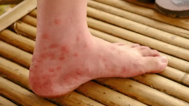 Widoczna wysypka na stopach, czerwone plamki na skórze, prawdopodobnie reakcja alergiczna lub ukąszenia.