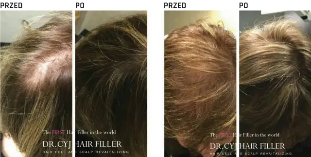 Przed i po zabiegu DR.CYJ Hair Filler. Włosy widocznie gęstsze i zdrowsze.