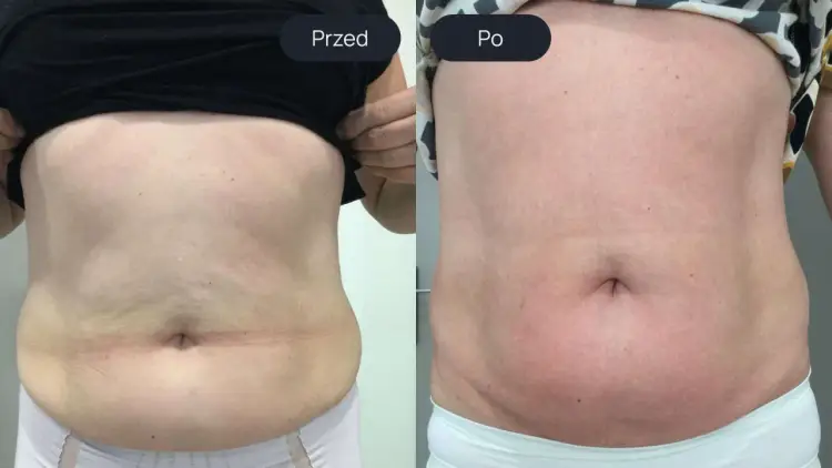 Endermologia - czy 5 zabiegów wystarczy? Poznaj realne efekty
